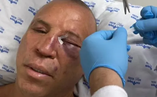 
          Imagem ilustrativa da imagem Wanderlei Silva teve nariz quebrado e recebeu pontos em briga após luta contra Popó
          