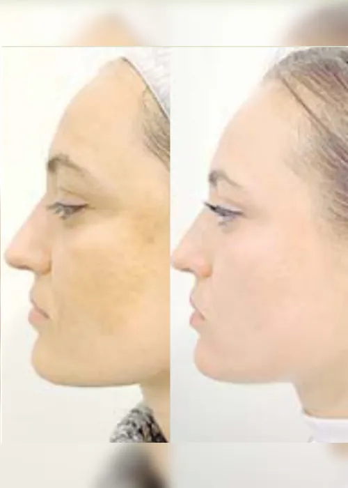 Imagem ilustrativa da imagem Tratamento de melasma sem efeito rebote