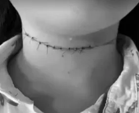 Imagem ilustrativa da imagem Criança de 10 anos é ferida no pescoço por linha com cerol em Camaragibe