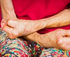 Imagem ilustrativa da imagem Pernambuco registra queda de 14,2% em casos novos de hanseníase, mas mantém alerta