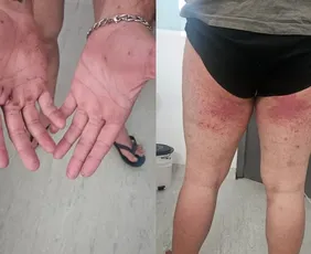 Imagem ilustrativa da imagem Pico Paraná: irmã mostra imagens das lesões do jovem que ficou desaparecido por 4 dias em trilha