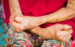 Imagem ilustrativa da imagem Pernambuco registra queda de 14,2% em casos novos de hanseníase, mas mantém alerta