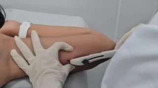 Imagem ilustrativa da imagem Recife amplia acesso a implante contraceptivo sob a pele na rede municipal de saúde