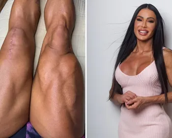 Imagem ilustrativa da imagem Gracyanne Barbosa mostra cicatrizes após cirurgia e desabafa sobre recuperação