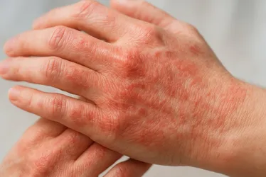 Imagem ilustrativa da imagem Brasil segue líder mundial em mortes por Chagas, aponta estudo