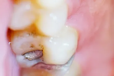 Imagem ilustrativa da imagem Brasil vai parar de usar restaurações prateadas de amálgama nos dentes