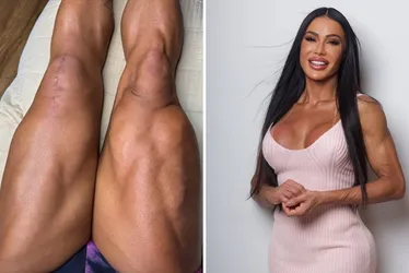 Imagem ilustrativa da imagem Gracyanne Barbosa mostra cicatrizes após cirurgia e desabafa sobre recuperação