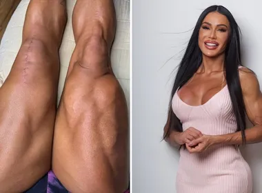 Imagem ilustrativa da imagem Gracyanne Barbosa mostra cicatrizes após cirurgia e desabafa sobre recuperação