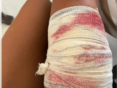 O atendimento definitivo ocorreu apenas no dia seguinte, quando o braço foi engessado