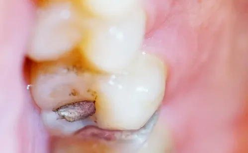 
          Imagem ilustrativa da imagem Brasil vai parar de usar restaurações prateadas de amálgama nos dentes
          