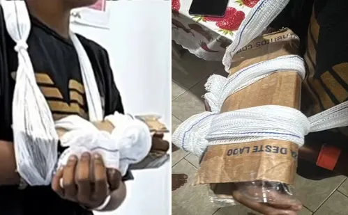 
          Imagem ilustrativa da imagem Criança tem braço imobilizado com papelão após fratura em UPA do RJ
          