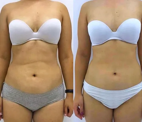 
          Imagem ilustrativa da imagem Endolaser combate flacidez e melhora saúde da pele
          