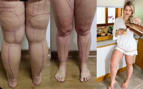 
          Imagem ilustrativa da imagem Estudo capixaba revela ação de remédio contra lipedema
          