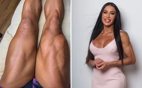 
          Imagem ilustrativa da imagem Gracyanne Barbosa mostra cicatrizes após cirurgia e desabafa sobre recuperação
          