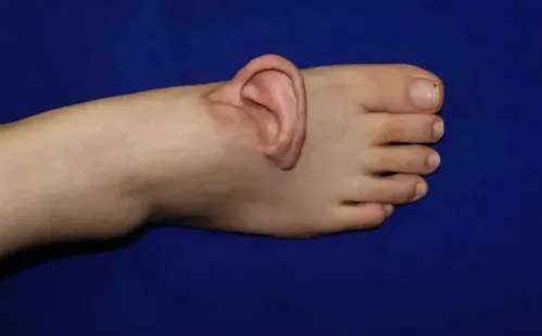 
          Imagem ilustrativa da imagem Médicos chineses enxertam orelha em pé de paciente
          