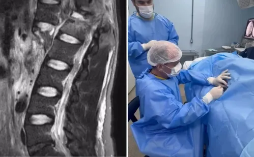 
          Imagem ilustrativa da imagem Paciente do ES que recebeu polilaminina mostra sensibilidade nas pernas
          