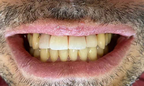 
          Imagem ilustrativa da imagem Sorriso novo em poucas horas
          