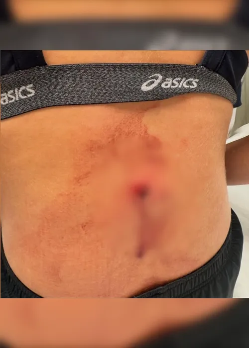 Imagem ilustrativa da imagem Atleta de vôlei é baleada em assalto no Rio: ‘Projétil entrou pelas minhas costas’, relata