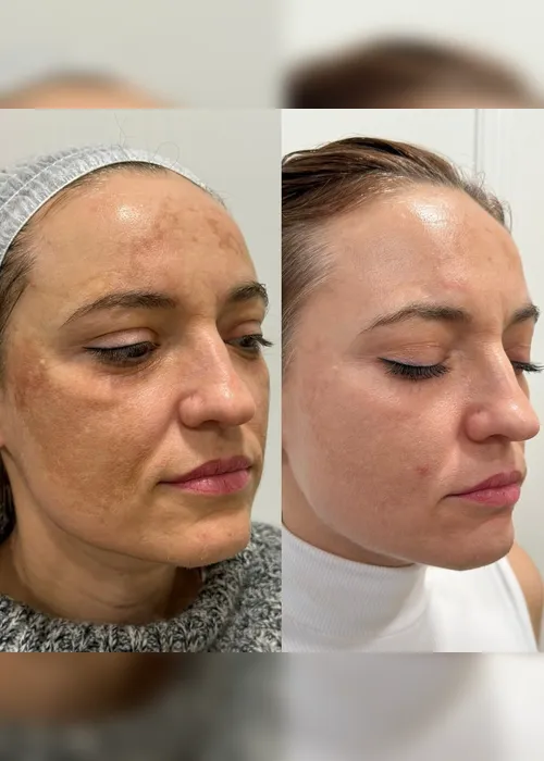 
          Imagem ilustrativa da imagem Endolaser combate flacidez e melhora saúde da pele
          