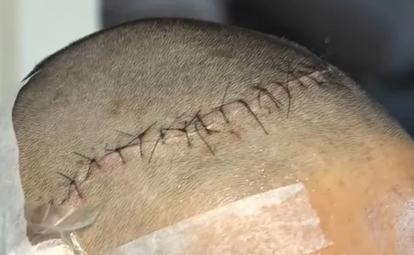 Imagem ilustrativa da imagem Adolescente sofre golpe em aula experimental de kickboxing e acaba internado na UTI