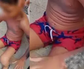 Imagem ilustrativa da imagem Criança sofre queimaduras de 3º grau após explosão de celular no Recife