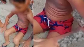 Imagem ilustrativa da imagem Criança sofre queimaduras de 3º grau após explosão de celular no Recife