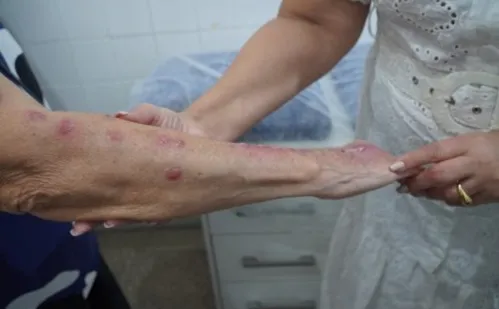 
          Imagem ilustrativa da imagem Esporotricose humana entra na lista de notificação compulsória no Brasil
          