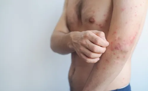 
          Imagem ilustrativa da imagem Ministério da Saúde alerta para risco de casos de sarampo após Copa
          