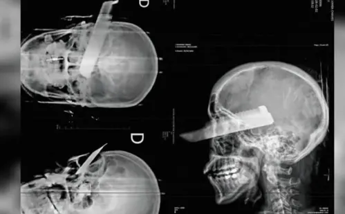 
          Imagem ilustrativa da imagem Mulher fica com faca cravada no olho após tentativa de feminicídio em SC
          