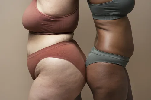 
          Imagem ilustrativa da imagem Não é gordura localizada nem celulite: entenda o que é o lipedema e como tratar
          
