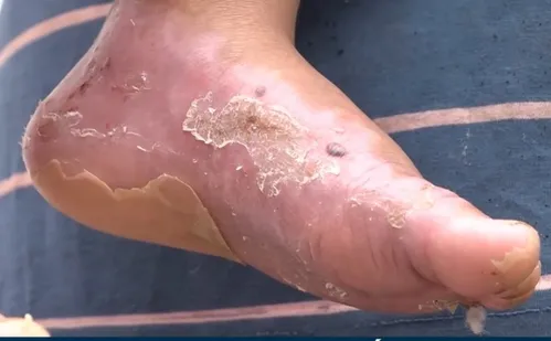 
          Imagem ilustrativa da imagem Pais acusam negligência em atendimento à criança com queimaduras nos pés
          