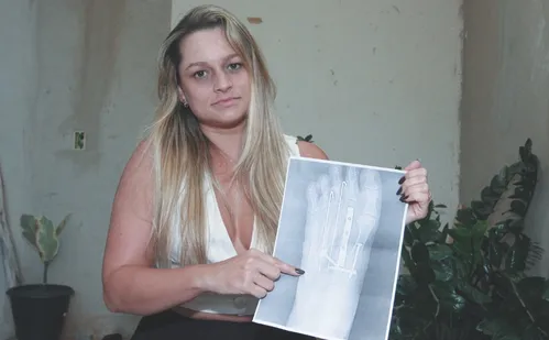 
          Imagem ilustrativa da imagem Sobreviventes de acidentes com motos lutam contra dores e depressão
          