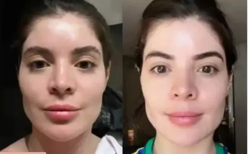 
          Imagem ilustrativa da imagem Tratamentos estéticos: mais mulheres buscam ajuda após exageros
          