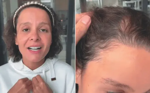 
          Imagem ilustrativa da imagem Alopecia: causas e tratamentos da doença que afeta famosos
          