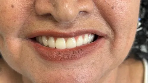 
          Imagem ilustrativa da imagem Implantes com carga imediata devolvem sorriso em poucas horas
          