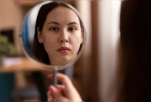 Alimentação também costuma ser associada ao aparecimento da acne