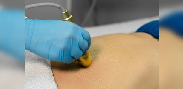 Após emagrecer, como tratar a flacidez com segurança