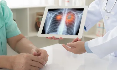 
          Imagem ilustrativa da imagem Anvisa aprova novo medicamento para câncer de pulmão avançado
          