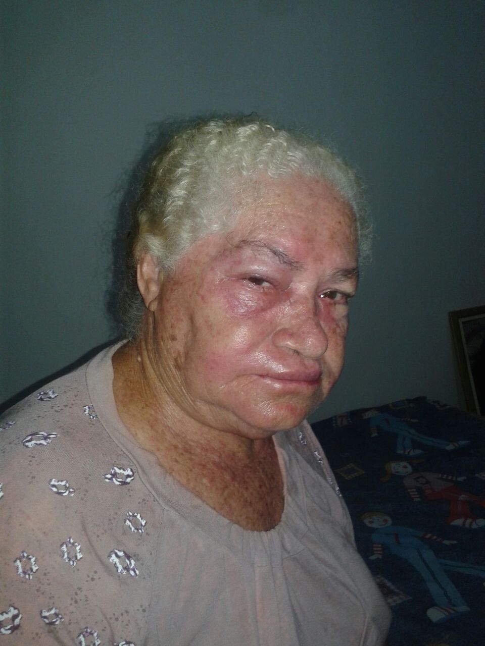 Moradora de 70 anos foi atacada pelo enxame de abelhas. Foto/ Whatsap.