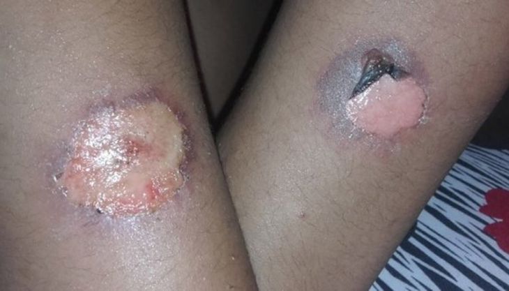 Desafio do desodorante gerou uma queimadura em cada braço do estudante de Cariacica. Foto: Reprodução/Facebook