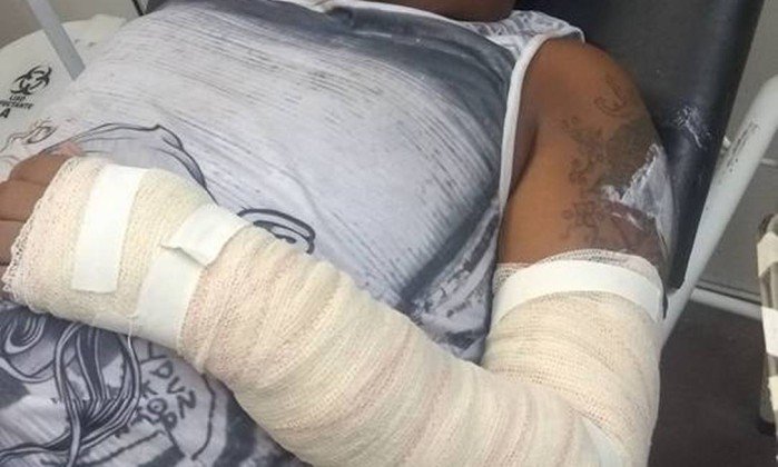 Ferido com óleo quente no braço - Foto/ Reprodução/Redes sociais