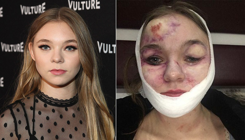 A atriz antes e depois do acidente. Fotos: Divulgação