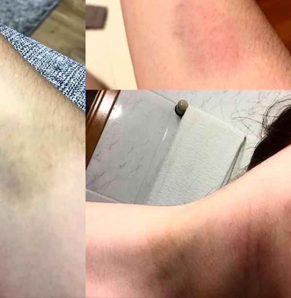 Atriz mostra hematomas (Foto: Reprodução Instagram)