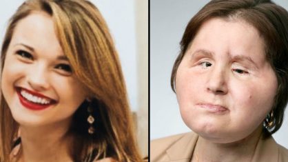 Resultado do transplante feito em Katie (Foto: Reprodução/ Twitter)