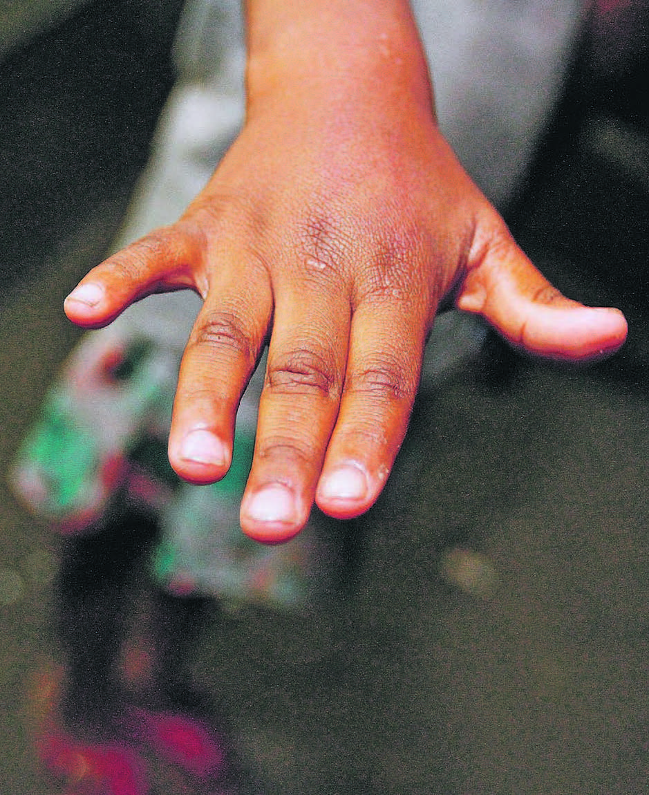Criança de 5 anos mostra, na delegacia de Caricica, a mão inchada. (Foto: Leone Iglesias)