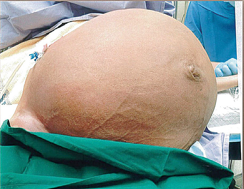 Barriga da paciente de 53 anos: útero e ovários foram removidos (Foto: Reprodução / Twitter)