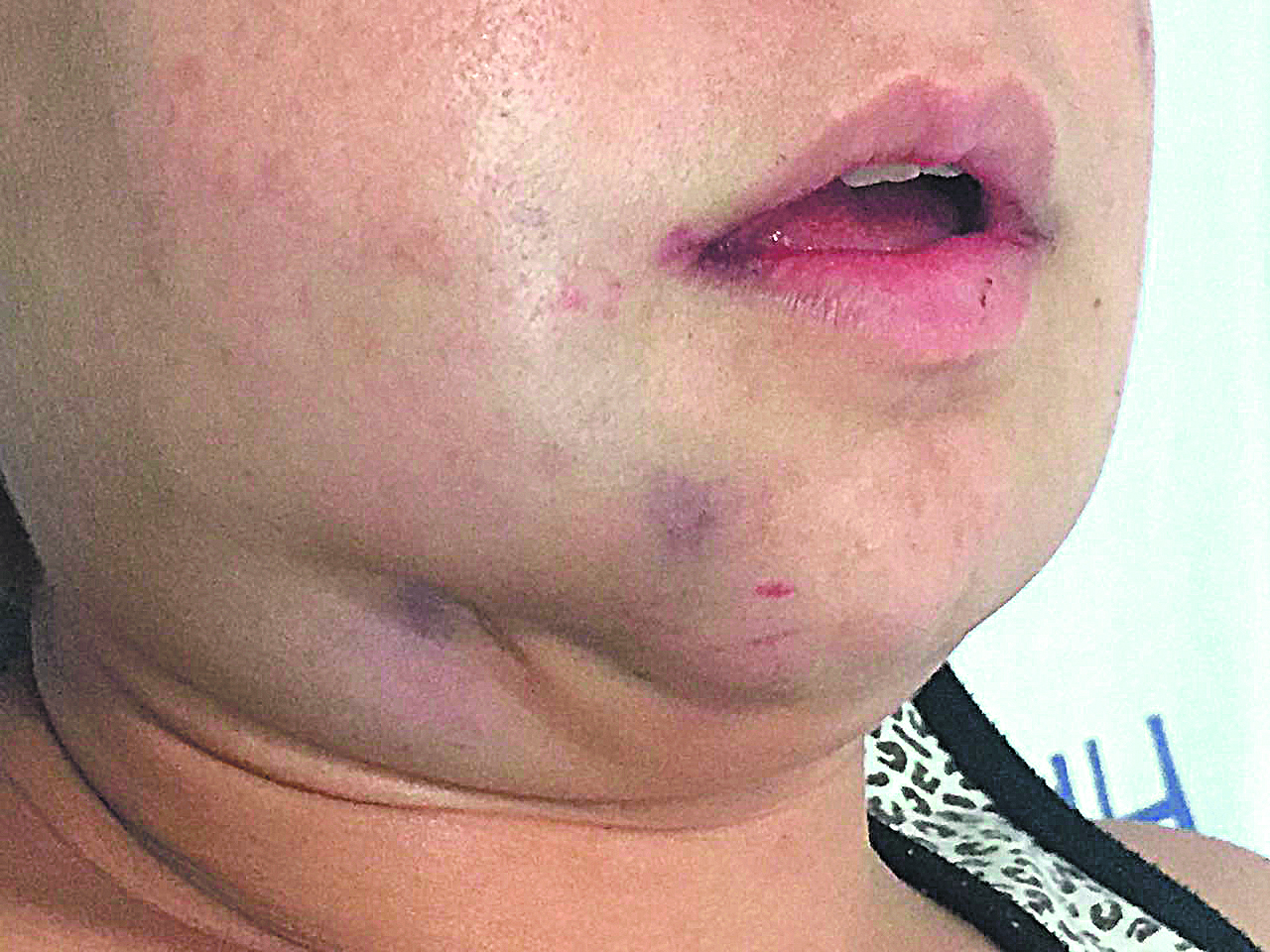 Enfermeira agredida teve o queixo quebrado (Foto: Arquivo AT)