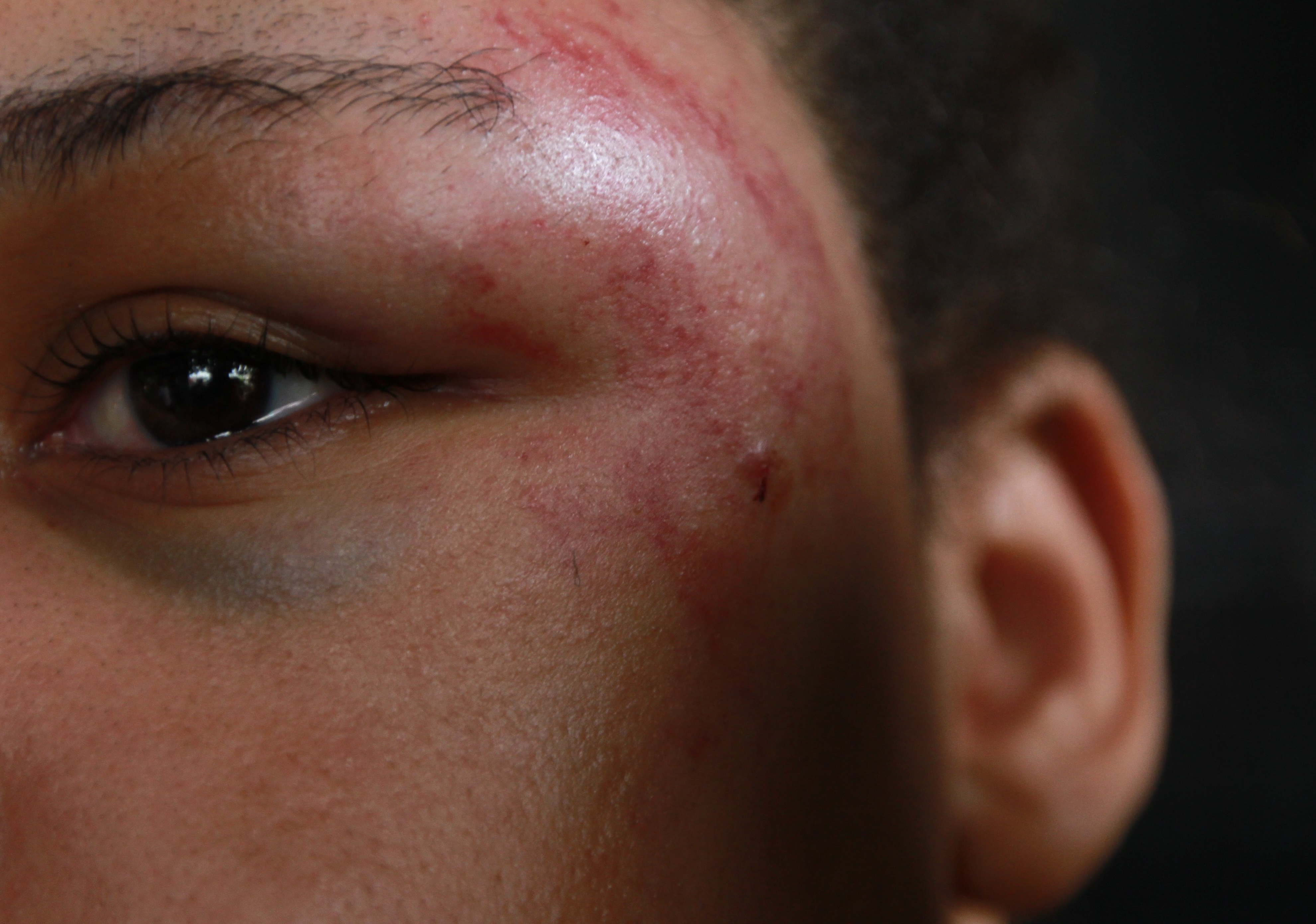 Vítima mostra hematomas no rosto. (Foto: Dayana Souza/AT)