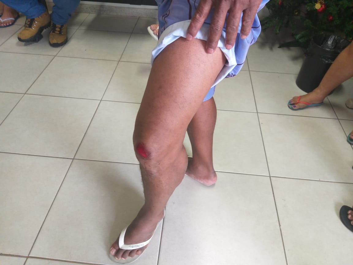 Ferimento causado pela briga que o aposentado se envolveu com o ex genro, para salvar a vida da filha (Foto: Simony Giuberti)