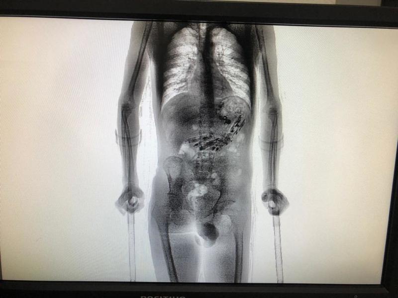 Scanner feito no preso identificou a presença de objetos (Foto: Divulgação)
